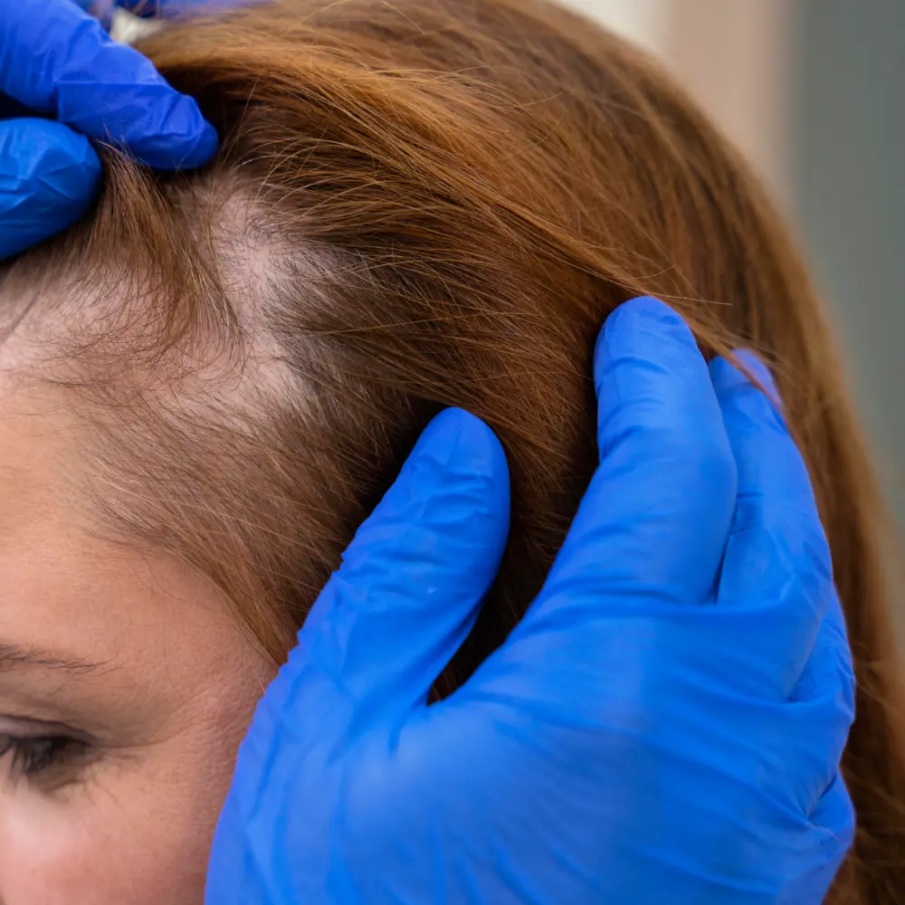 women with perimenopause hair loss